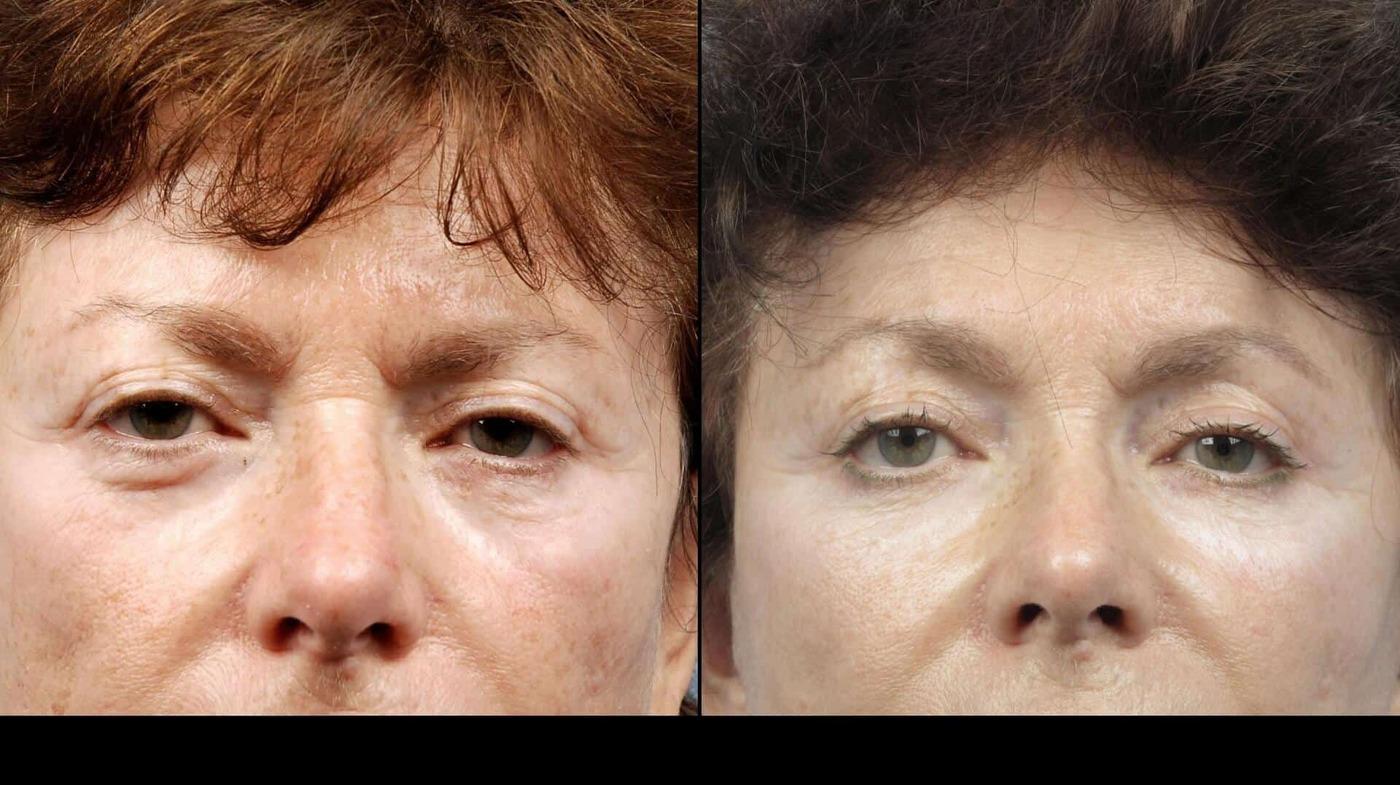 Dermal Fillers in Toronto Before and After. Image 56