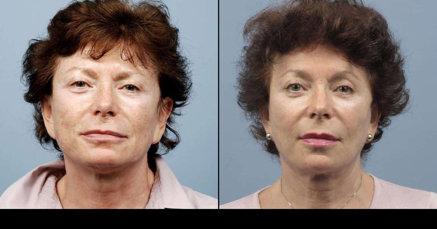 Dermal Fillers in Toronto Before and After. Image 57