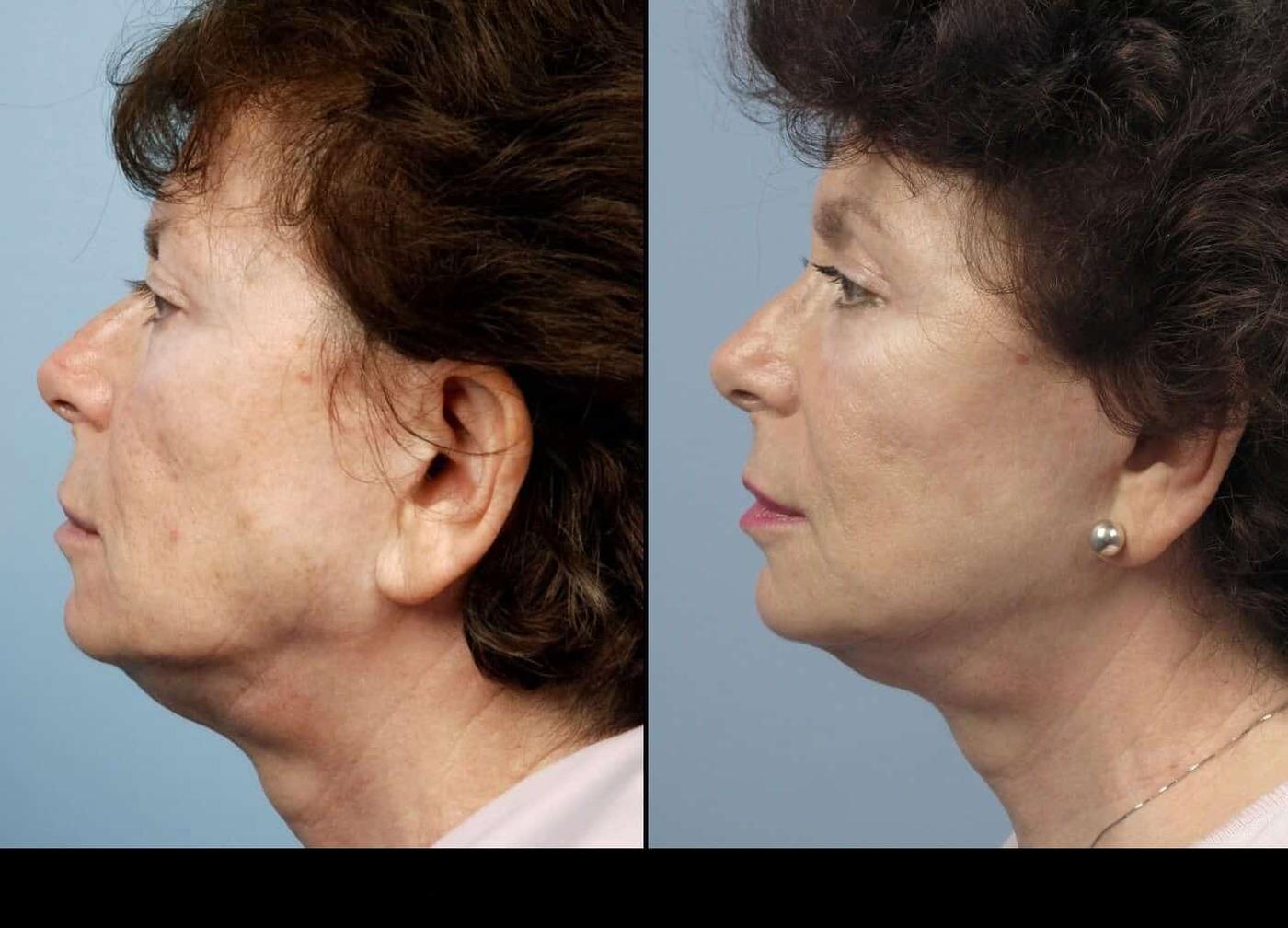 Dermal Fillers in Toronto Before and After. Image 58