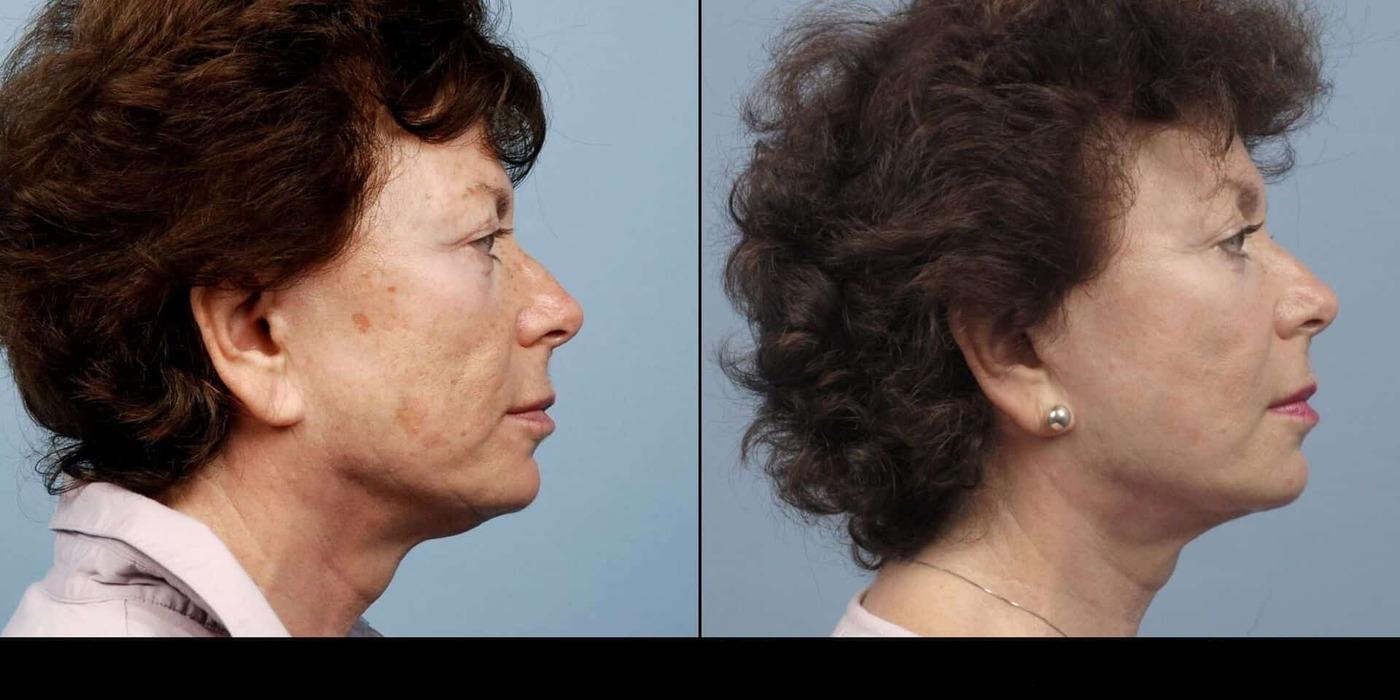 Dermal Fillers in Toronto Before and After. Image 59