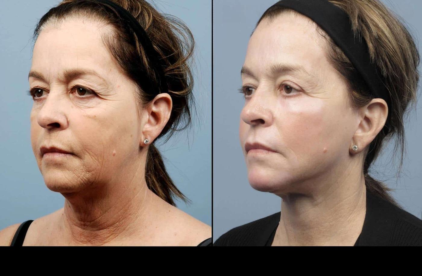 Dermal Fillers in Toronto Before and After. Image 6