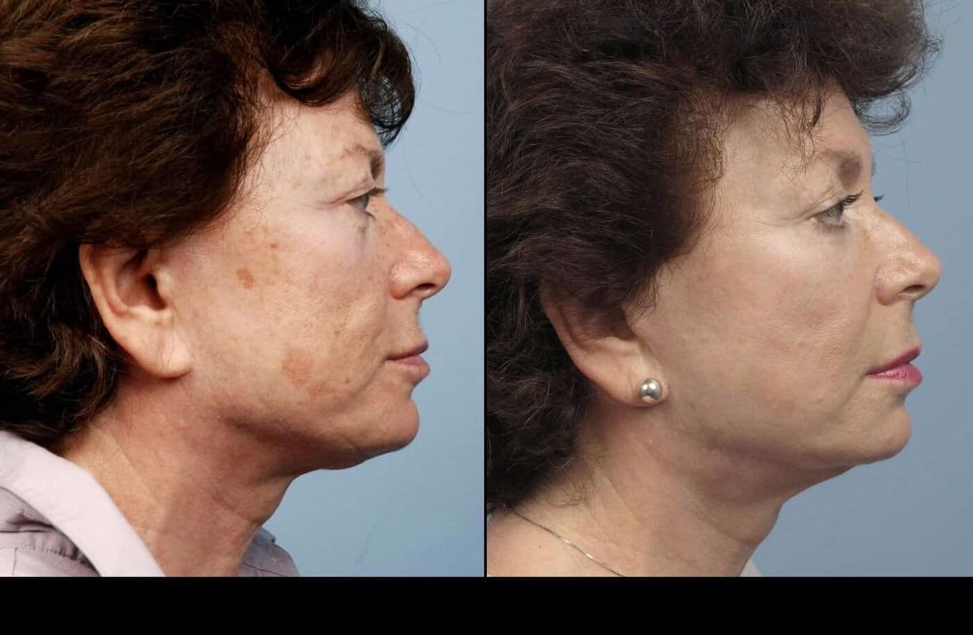 Dermal Fillers in Toronto Before and After. Image 60