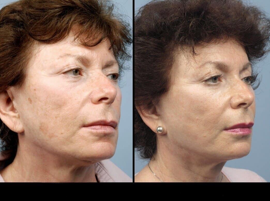 Dermal Fillers in Toronto Before and After. Image 61