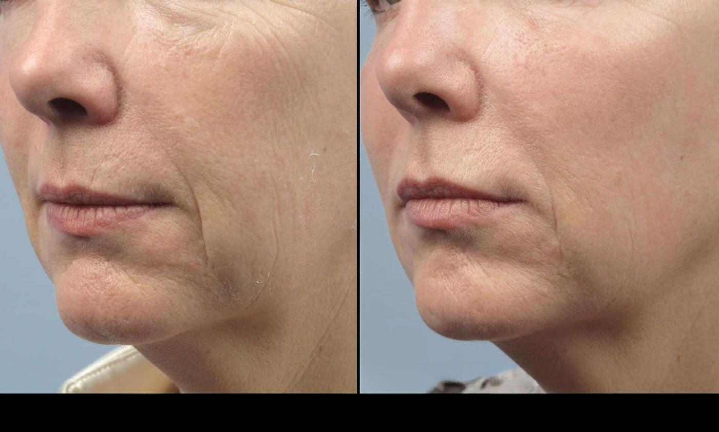 Dermal Fillers in Toronto Before and After. Image 62