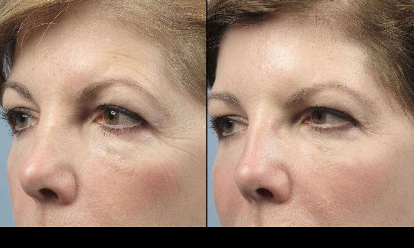 Dermal Fillers in Toronto Before and After. Image 63