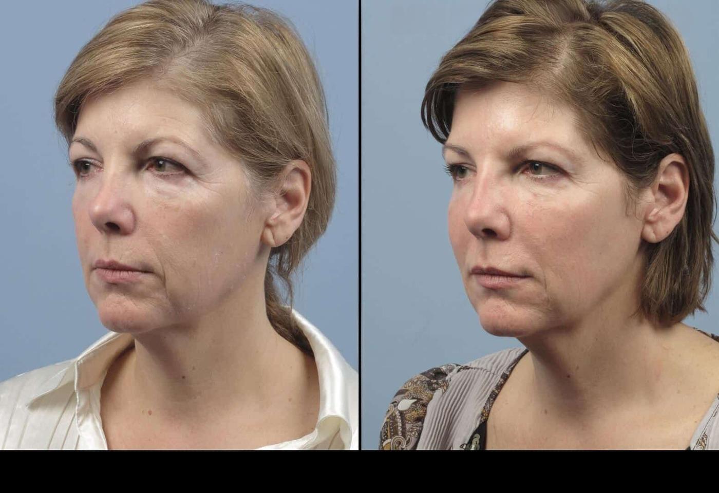 Dermal Fillers in Toronto Before and After. Image 64