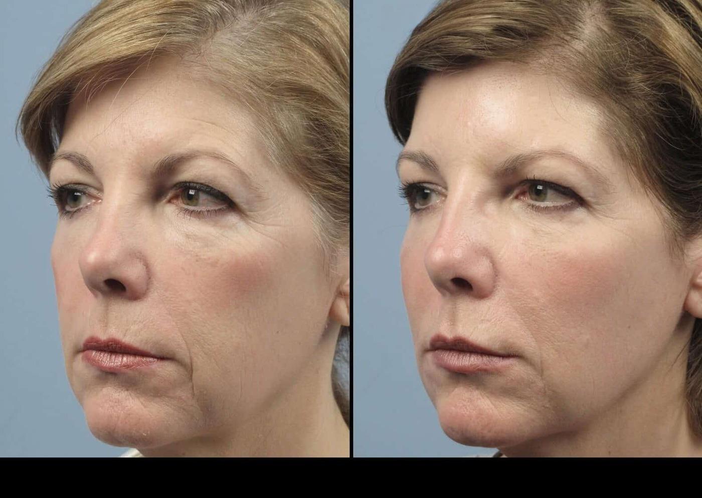 Dermal Fillers in Toronto Before and After. Image 65