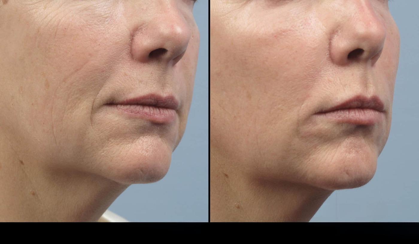 Dermal Fillers in Toronto Before and After. Image 66
