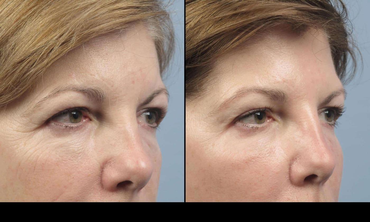 Dermal Fillers in Toronto Before and After. Image 67