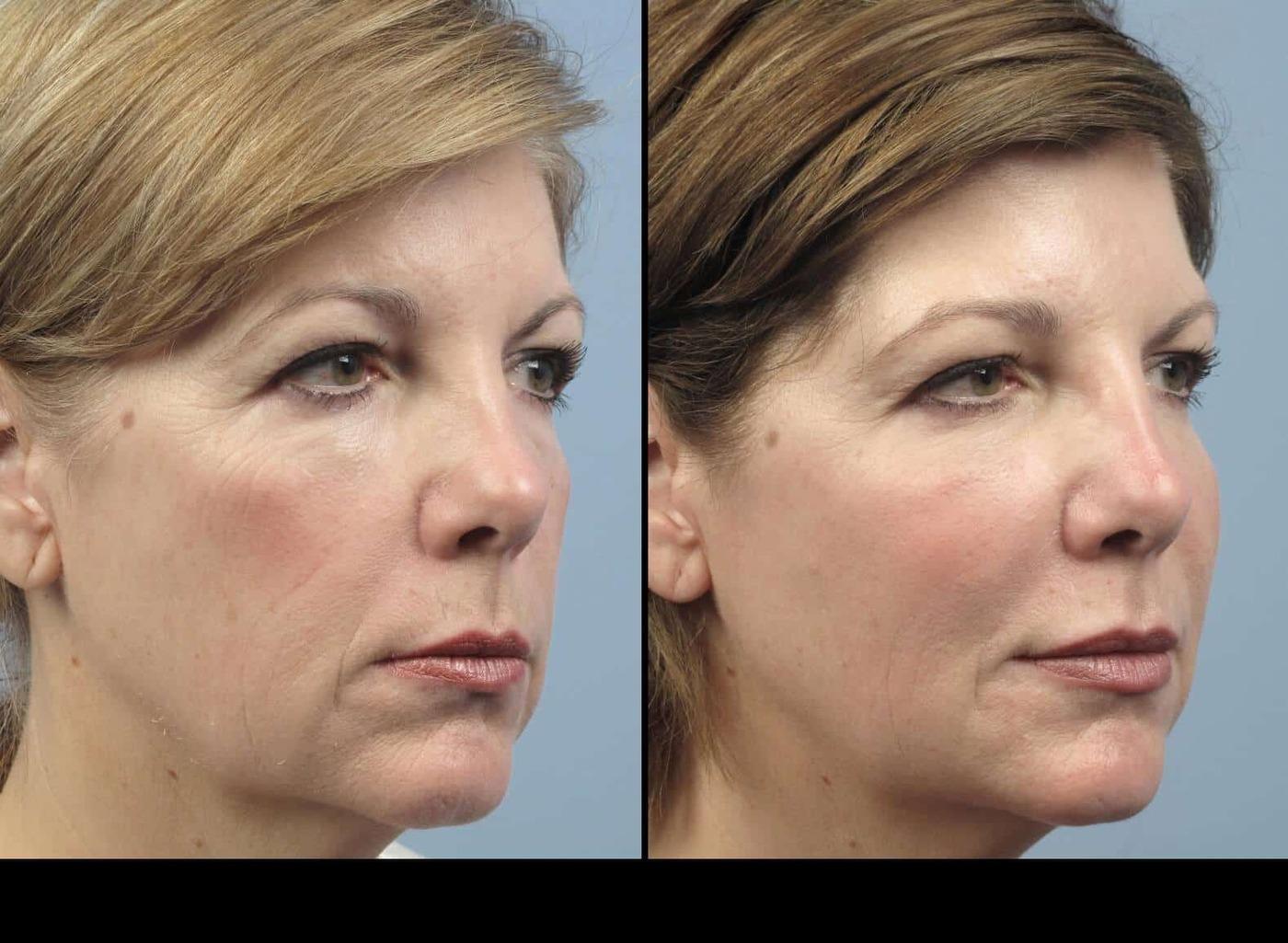 Dermal Fillers in Toronto Before and After. Image 69