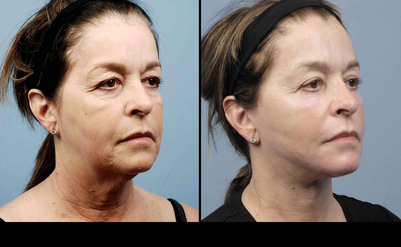 Dermal Fillers in Toronto Before and After. Image 7