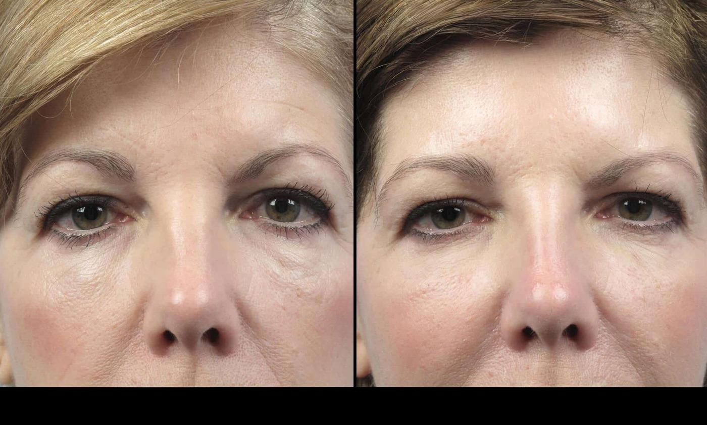Dermal Fillers in Toronto Before and After. Image 70