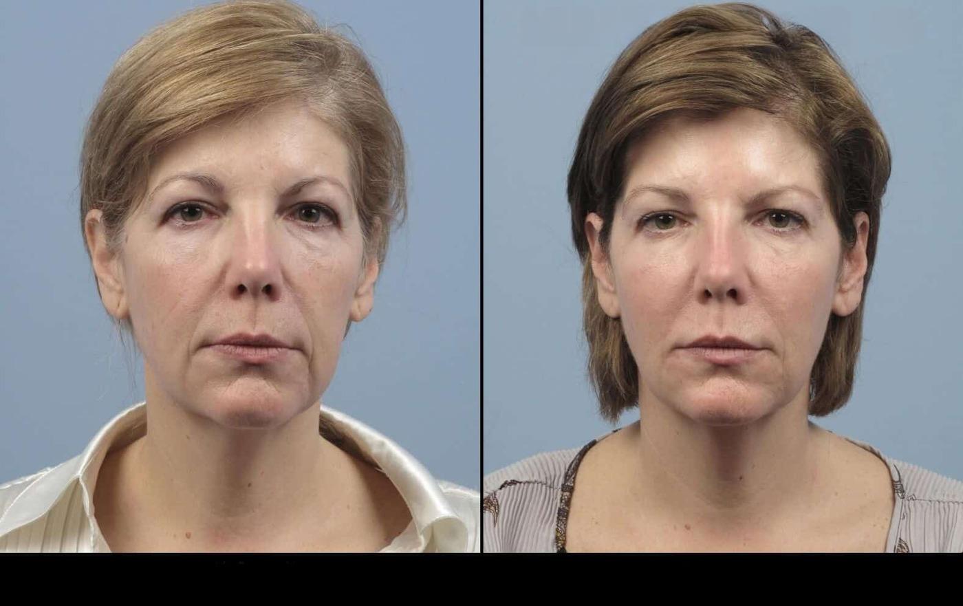 Dermal Fillers in Toronto Before and After. Image 71