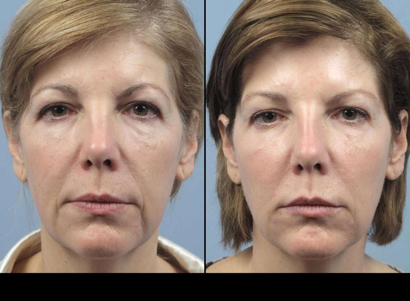 Dermal Fillers in Toronto Before and After. Image 72