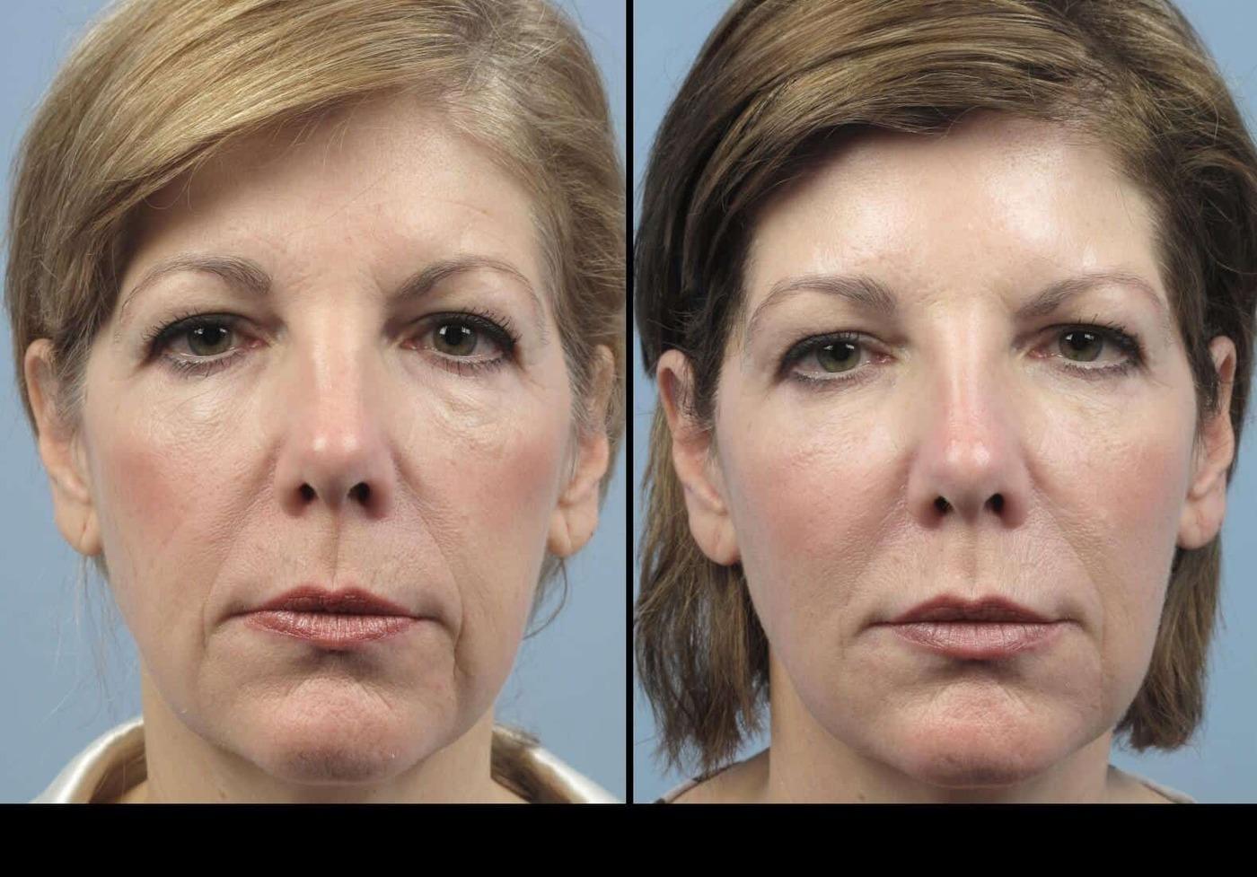 Dermal Fillers in Toronto Before and After. Image 73