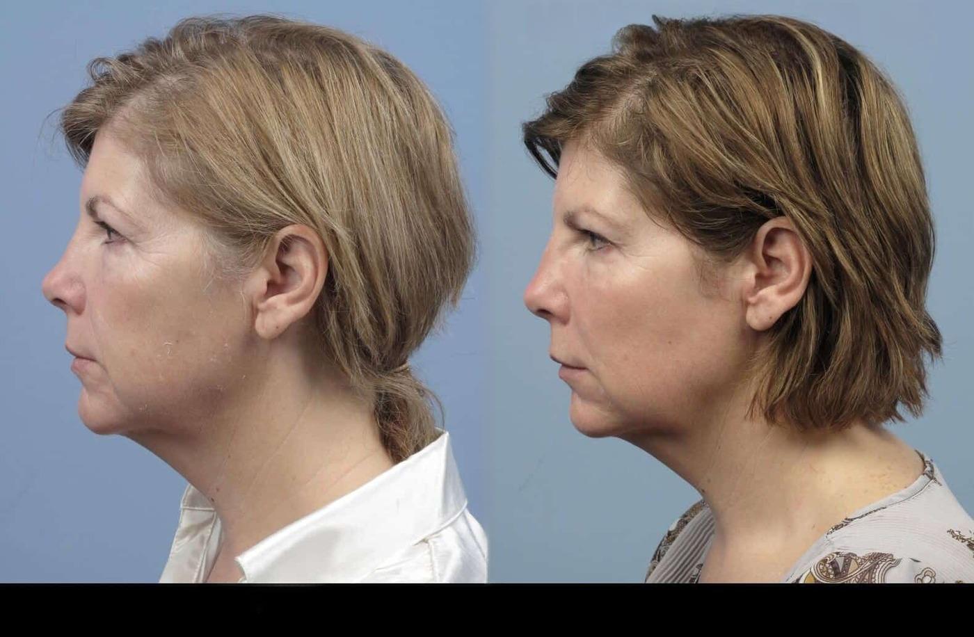 Dermal Fillers in Toronto Before and After. Image 74