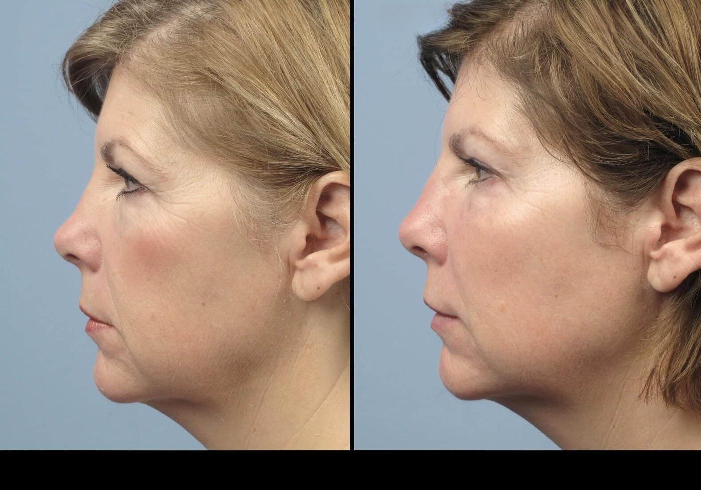 Dermal Fillers in Toronto Before and After. Image 75