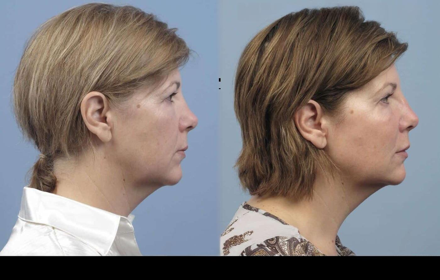 Dermal Fillers in Toronto Before and After. Image 76