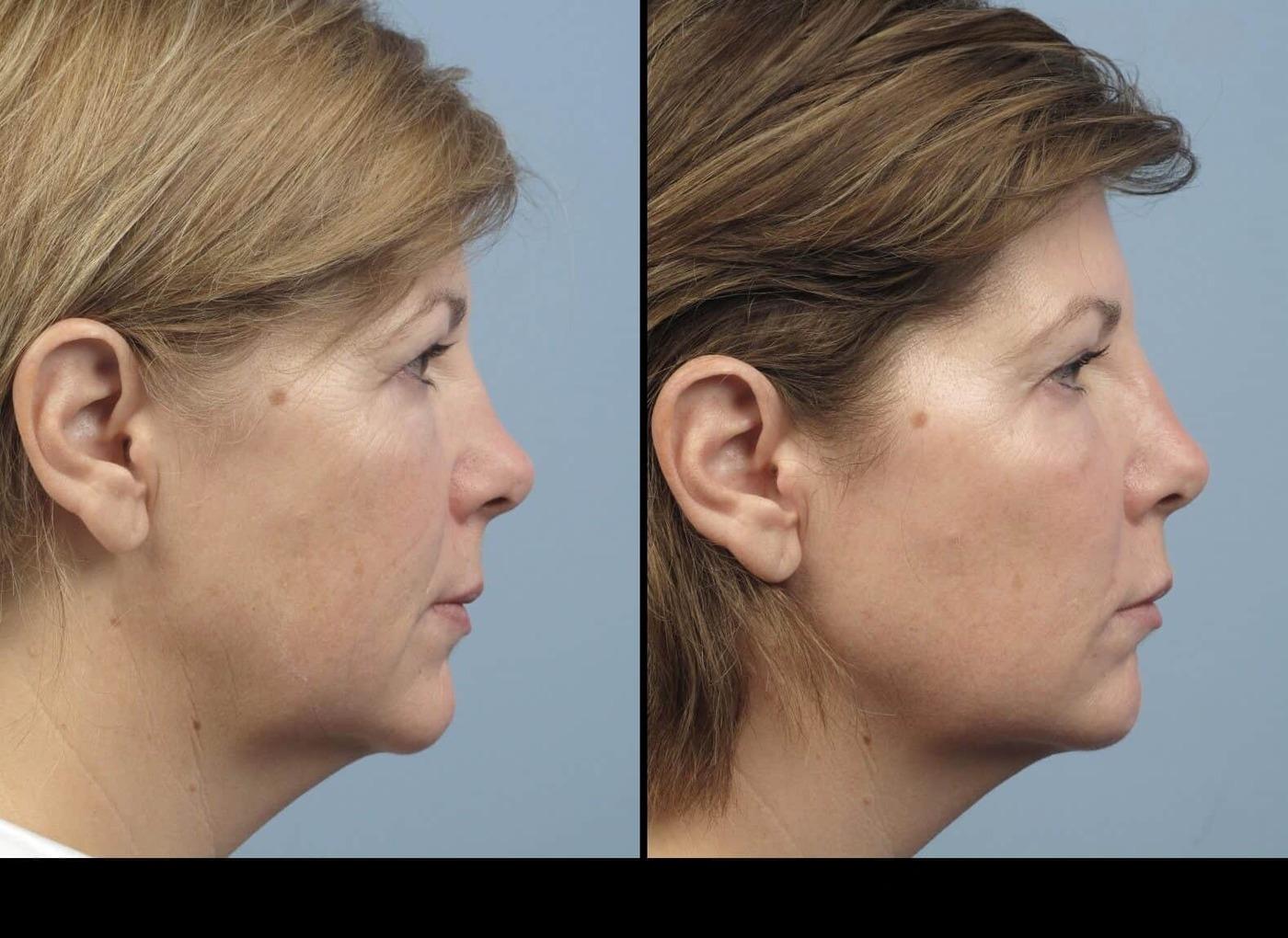 Dermal Fillers in Toronto Before and After. Image 77