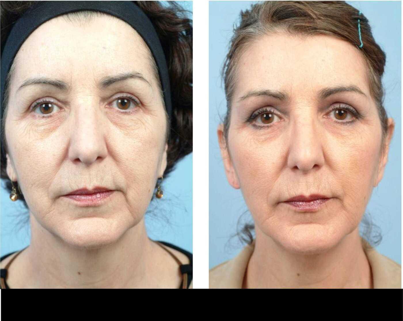 Dermal Fillers in Toronto Before and After. Image 78