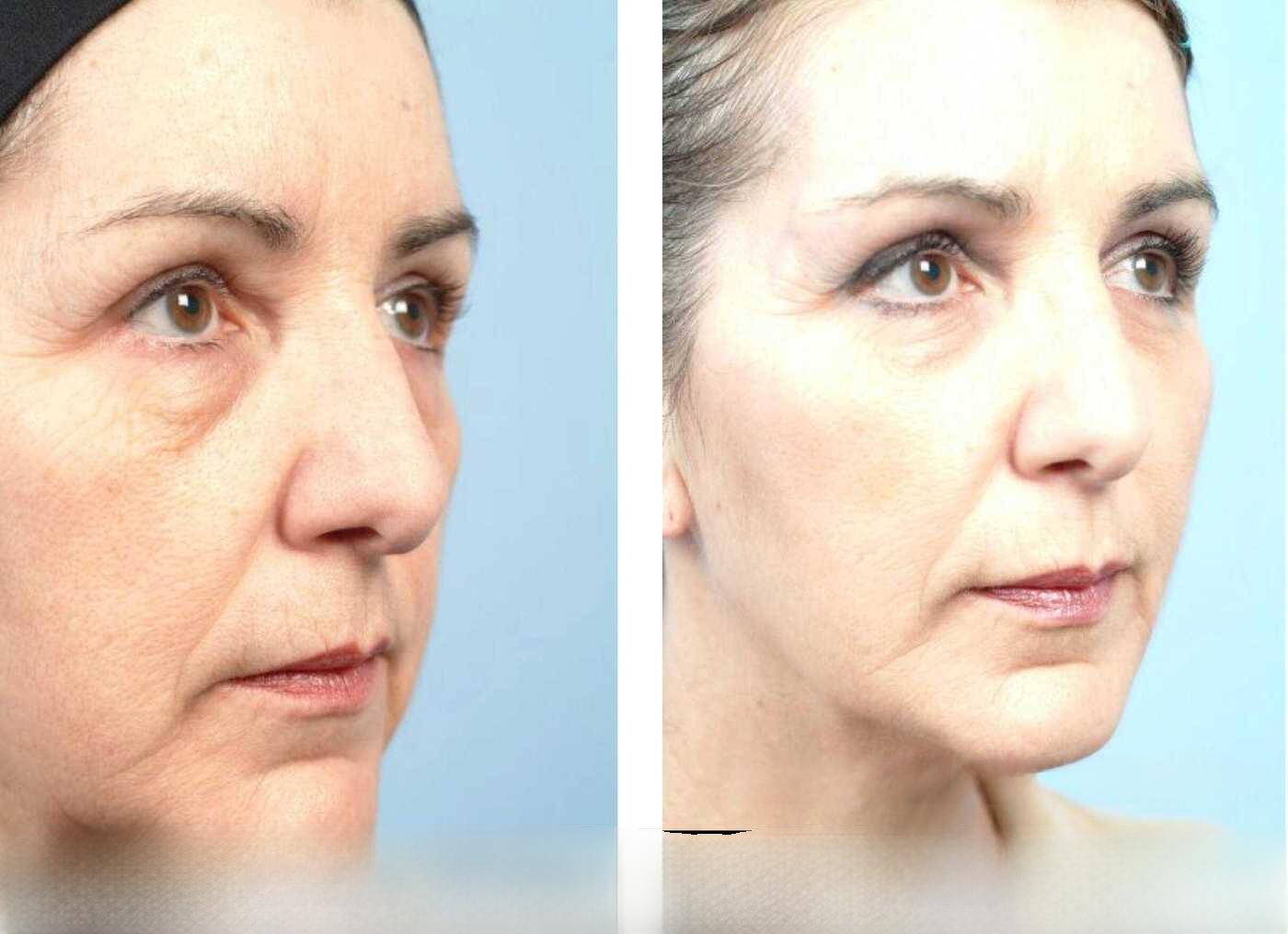 Dermal Fillers in Toronto Before and After. Image 79