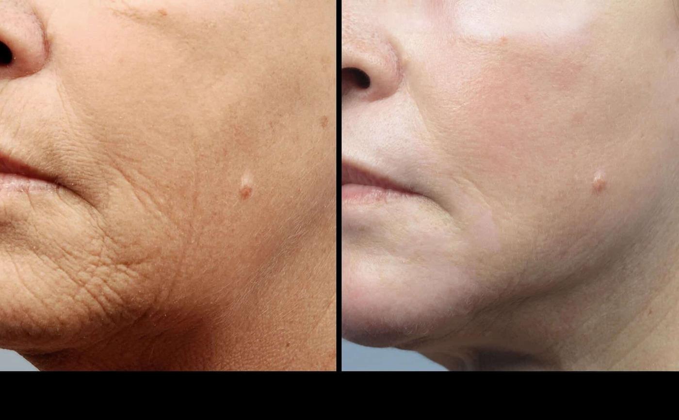 Dermal Fillers in Toronto Before and After. Image 8