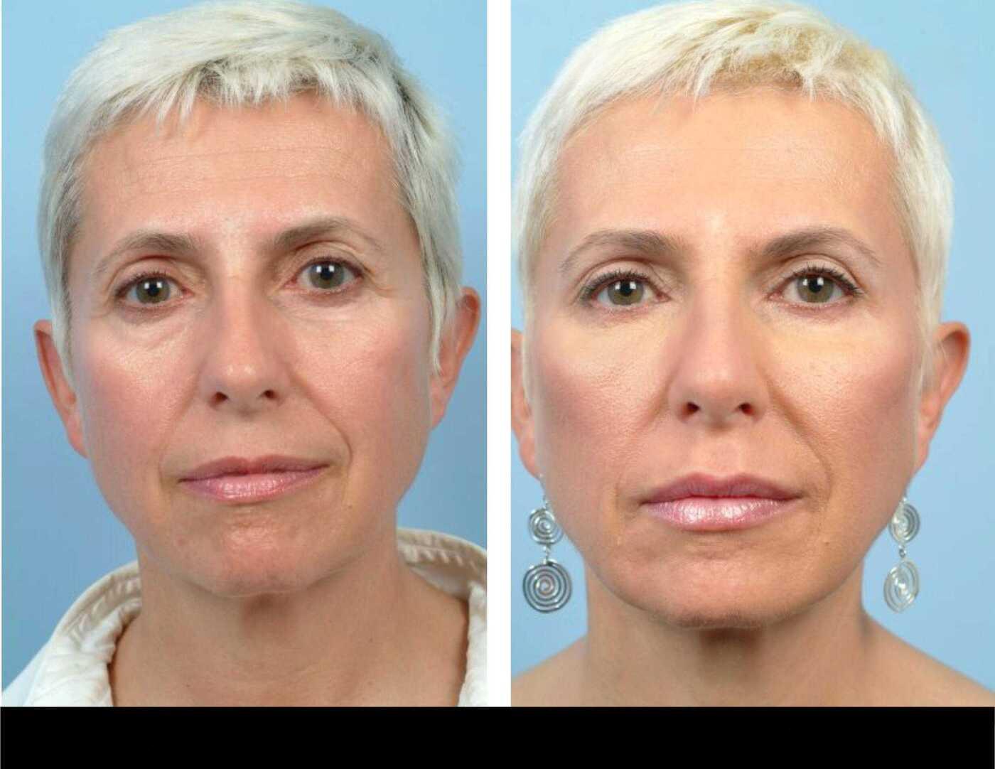 Dermal Fillers in Toronto Before and After. Image 80