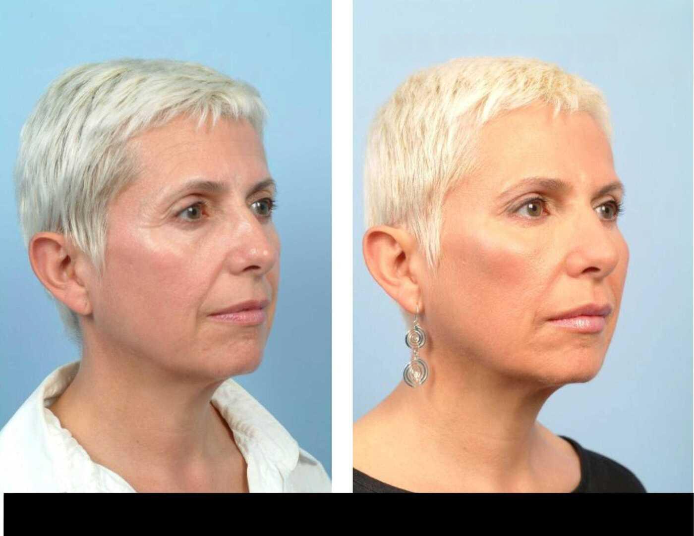 Dermal Fillers in Toronto Before and After. Image 81