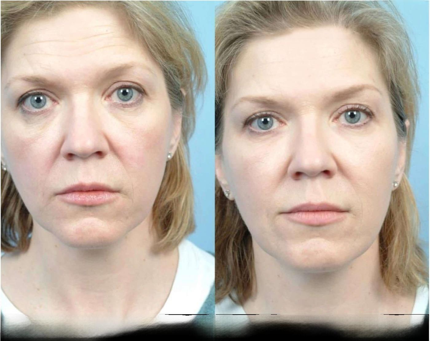 Dermal Fillers in Toronto Before and After. Image 82