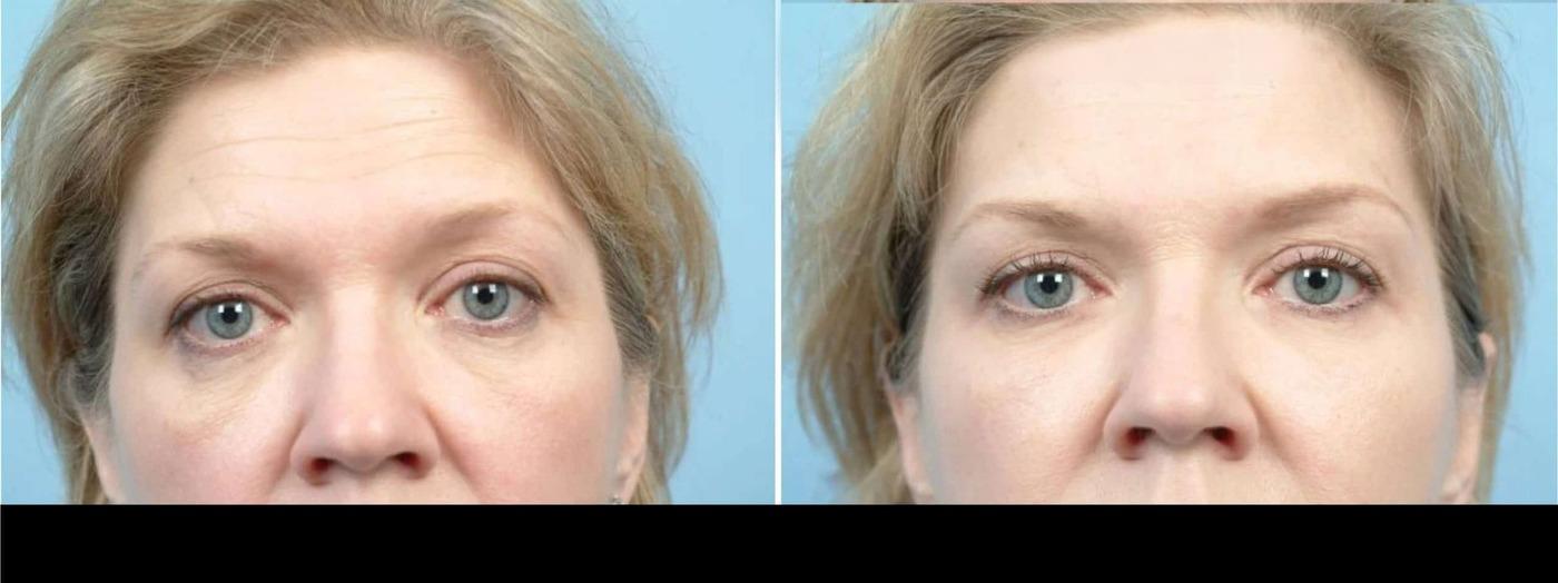 Dermal Fillers in Toronto Before and After. Image 83