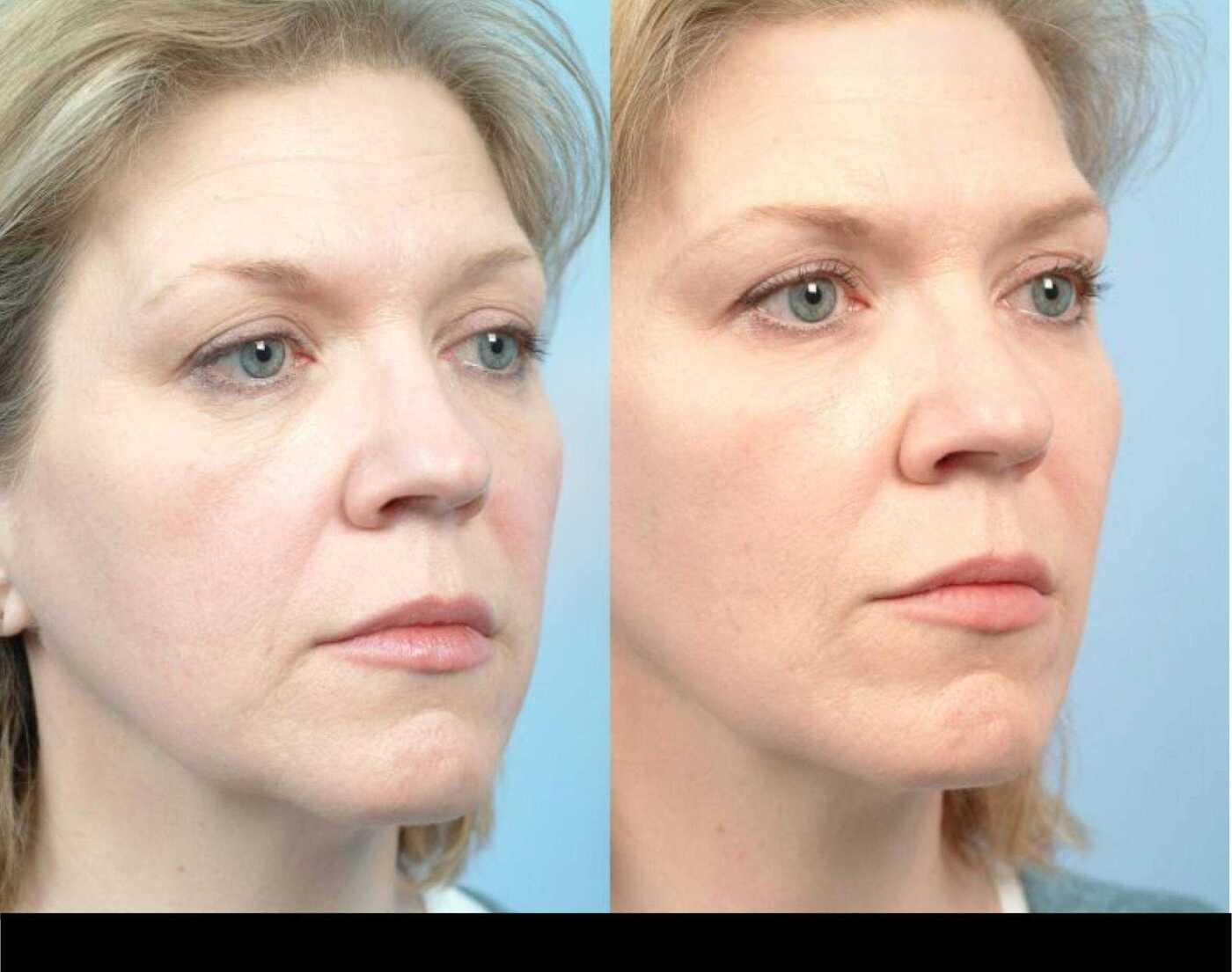 Dermal Fillers in Toronto Before and After. Image 84