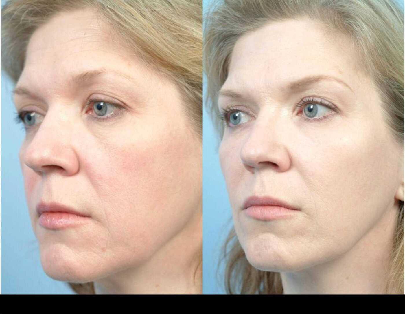 Dermal Fillers in Toronto Before and After. Image 85