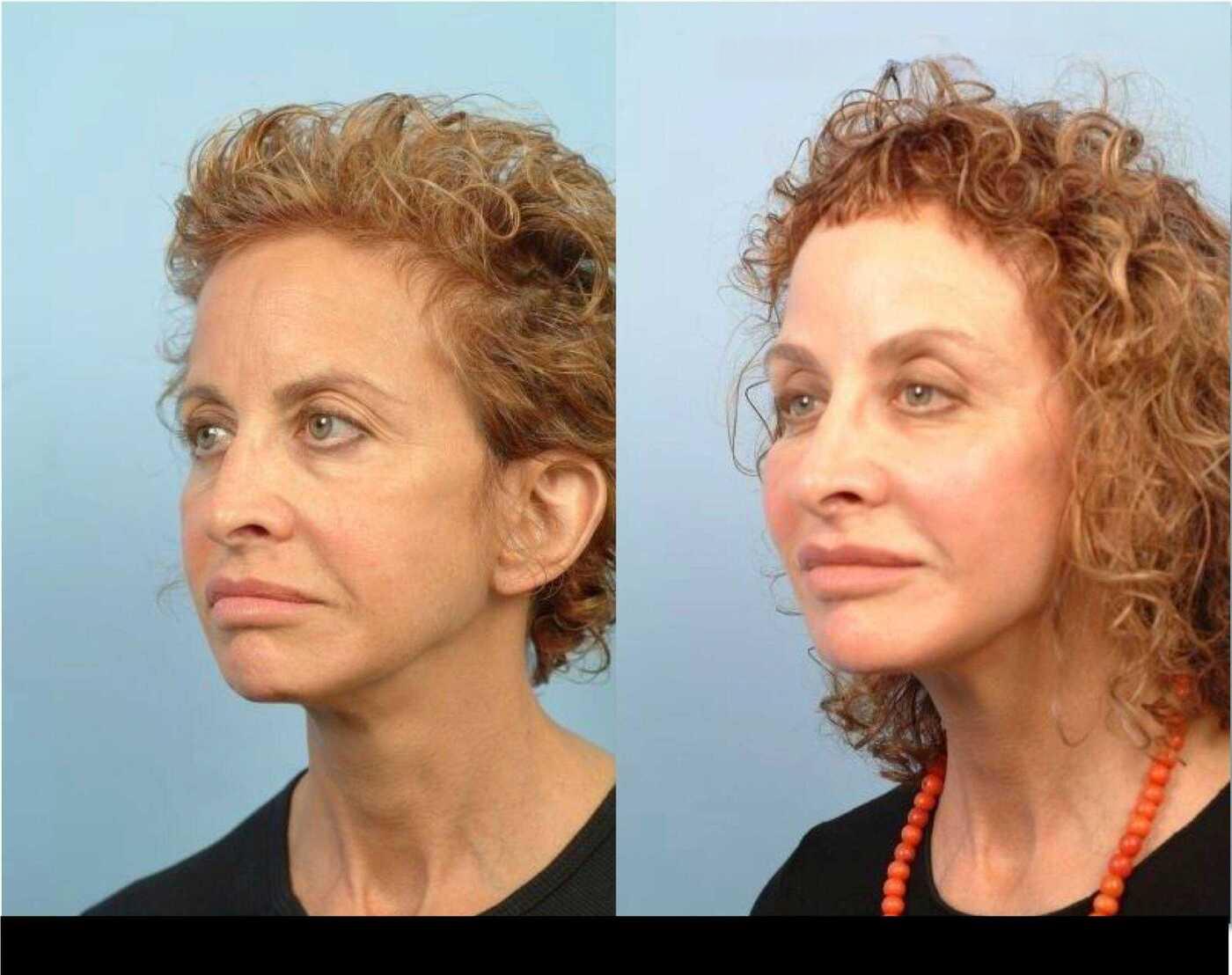 Dermal Fillers in Toronto Before and After. Image 86