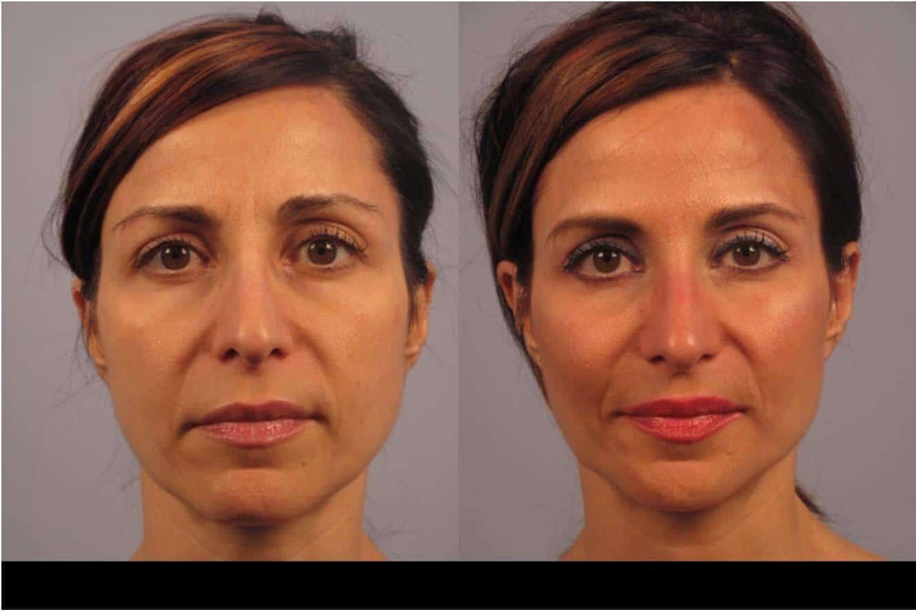 Dermal Fillers in Toronto Before and After. Image 87