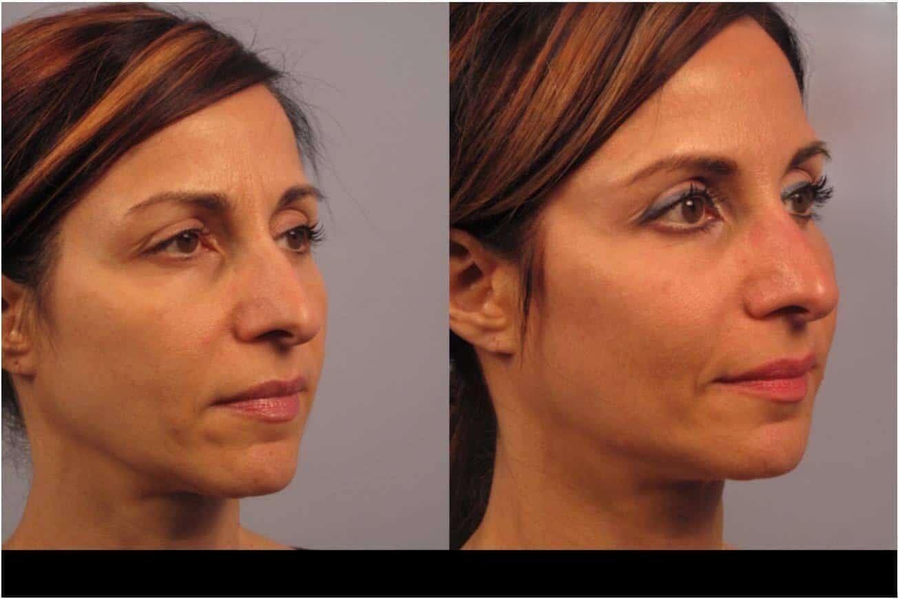 Dermal Fillers in Toronto Before and After. Image 88