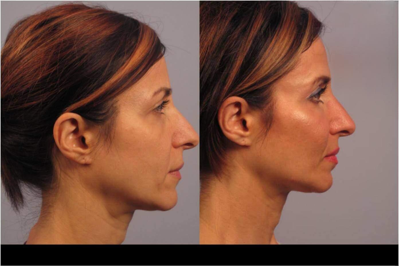 Dermal Fillers in Toronto Before and After. Image 89