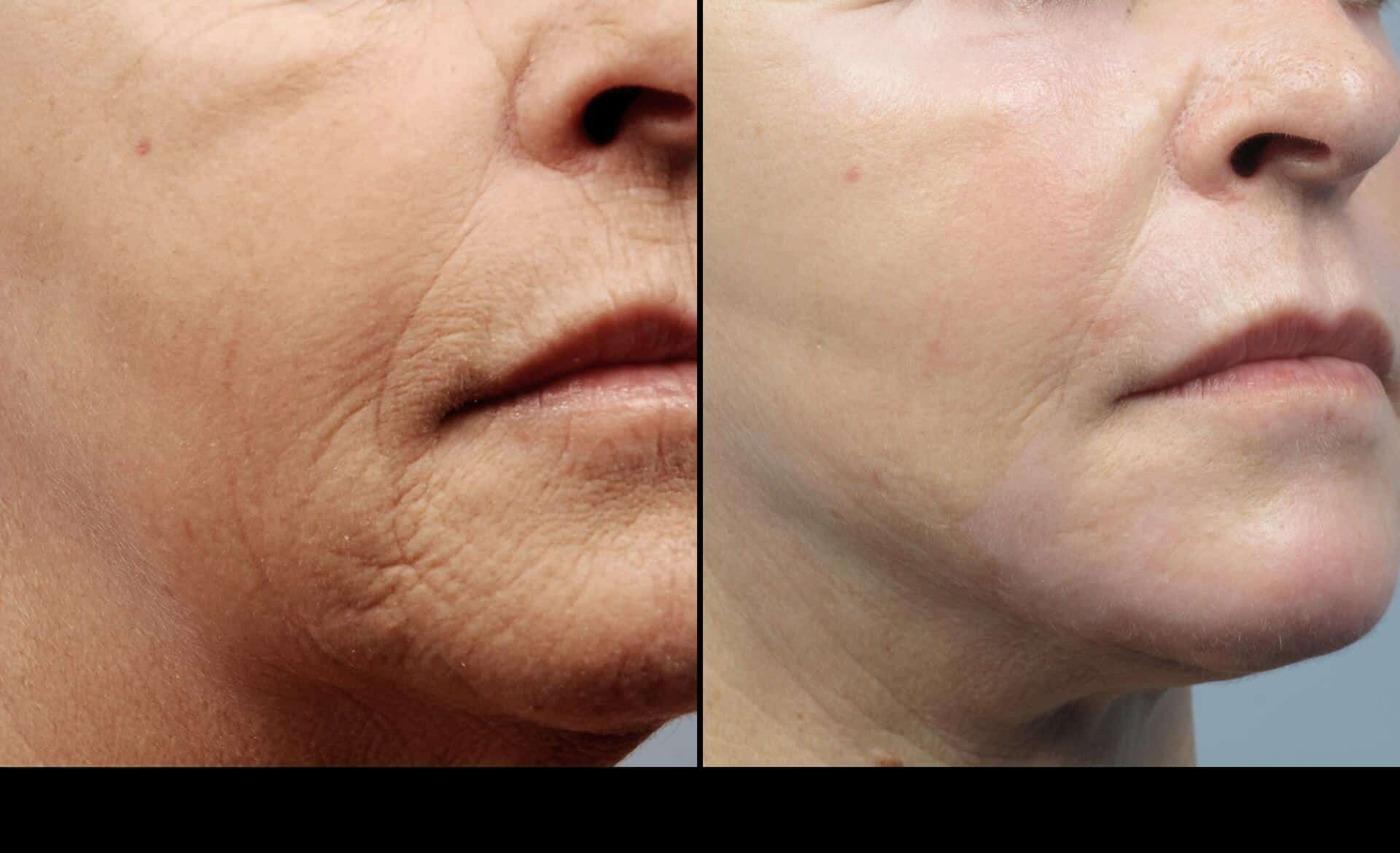 Dermal Fillers in Toronto Before and After. Image 9