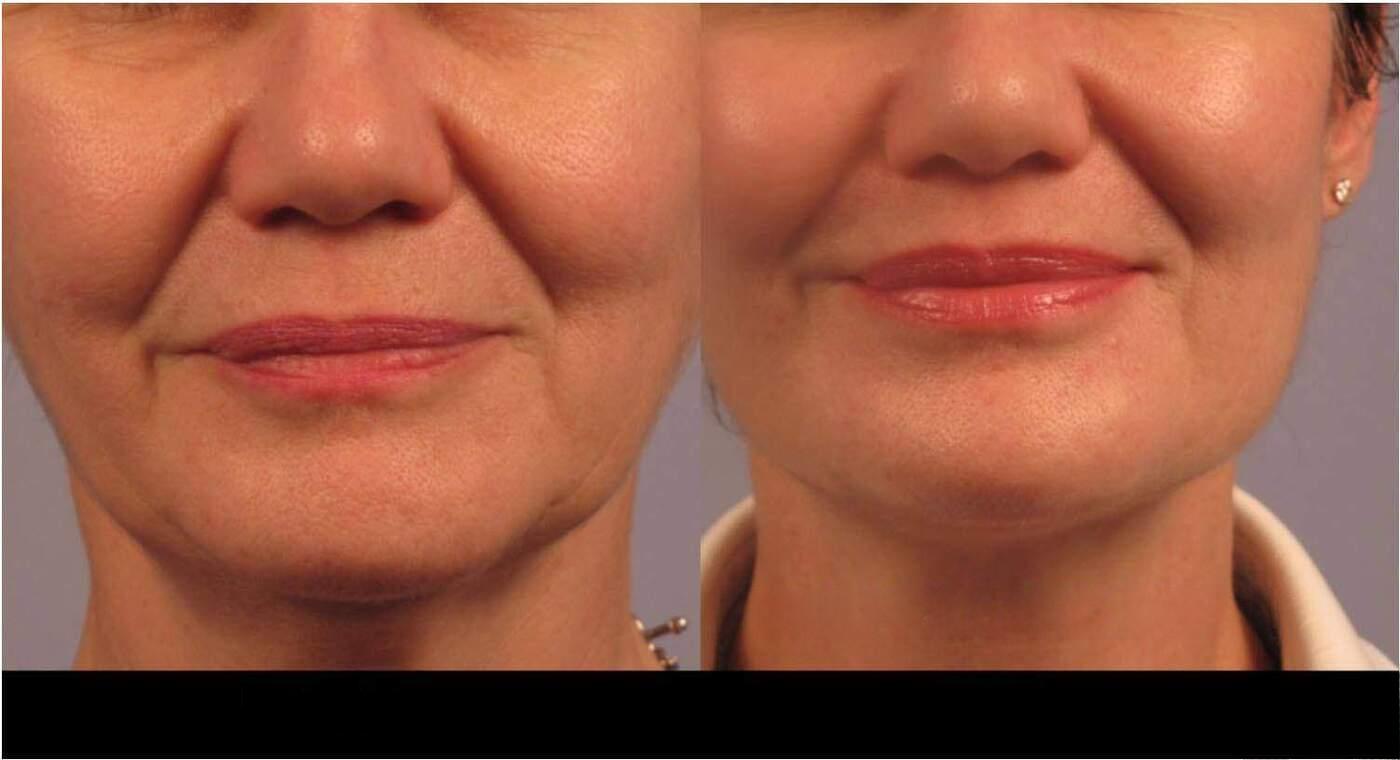 Dermal Fillers in Toronto Before and After. Image 90