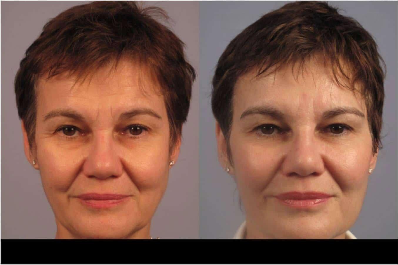 Dermal Fillers in Toronto Before and After. Image 91