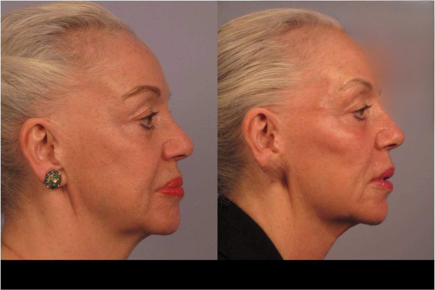 Dermal Fillers in Toronto Before and After. Image 92