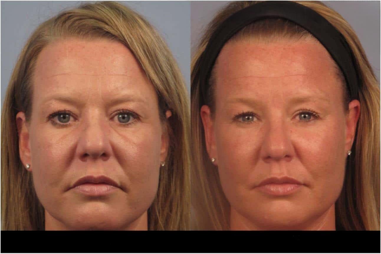 Dermal Fillers in Toronto Before and After. Image 93