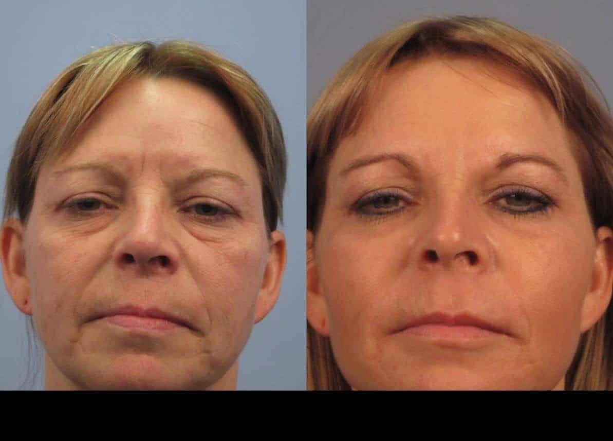 Dermal Fillers in Toronto Before and After. Image 94