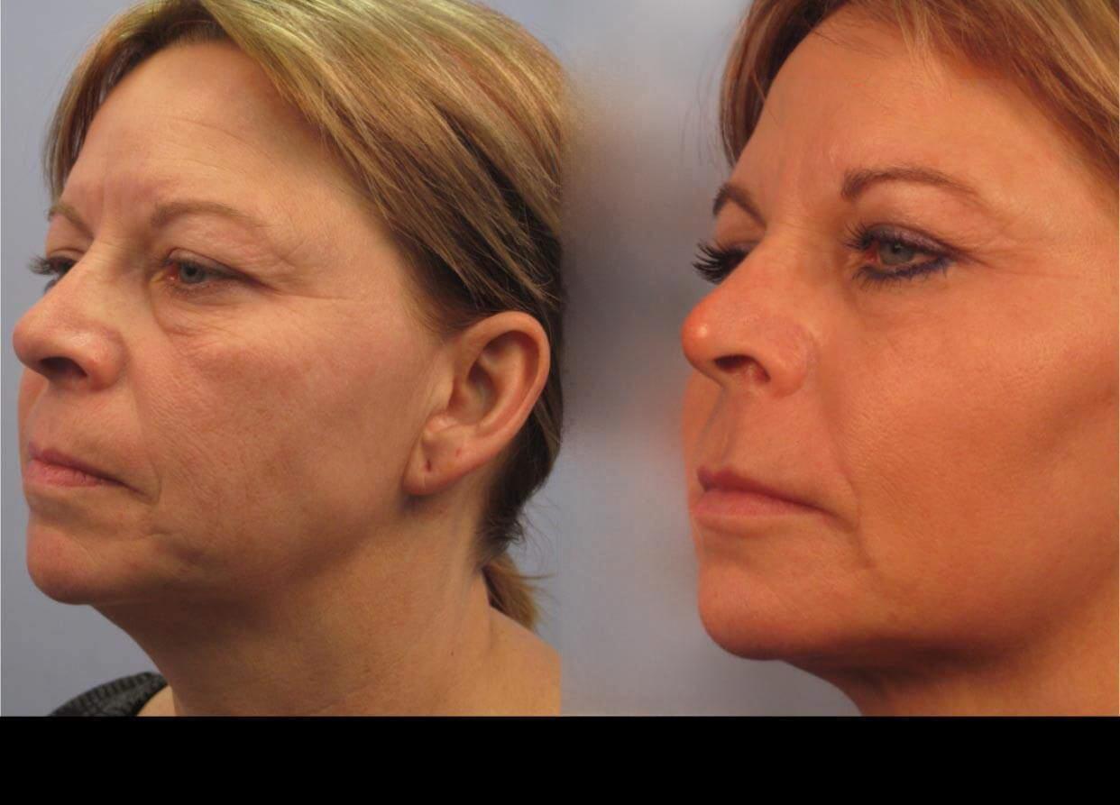 Dermal Fillers in Toronto Before and After. Image 95