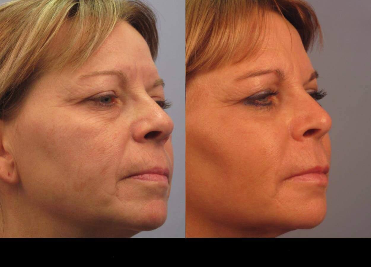 Dermal Fillers in Toronto Before and After. Image 96