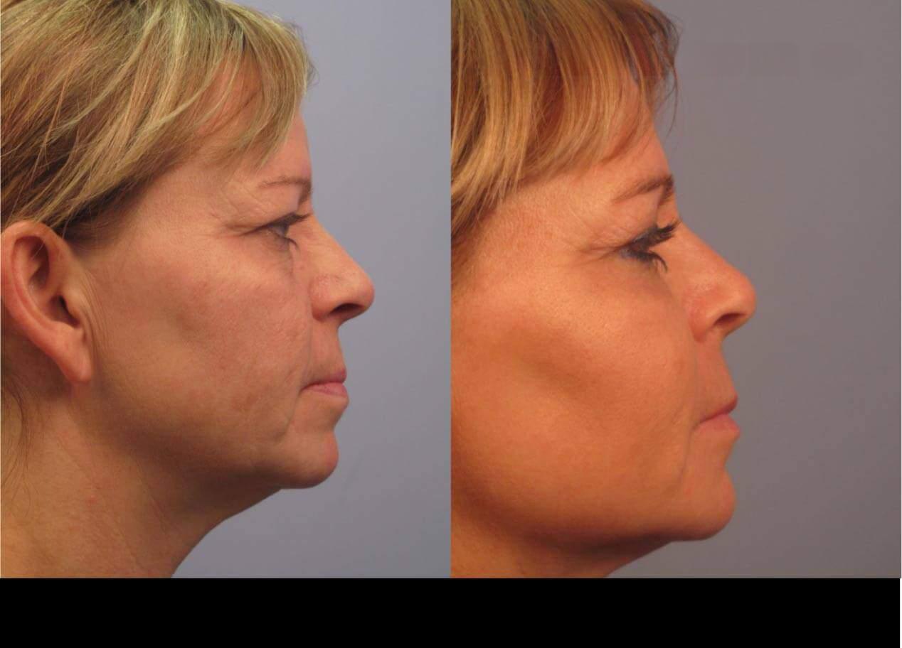 Dermal Fillers in Toronto Before and After. Image 97