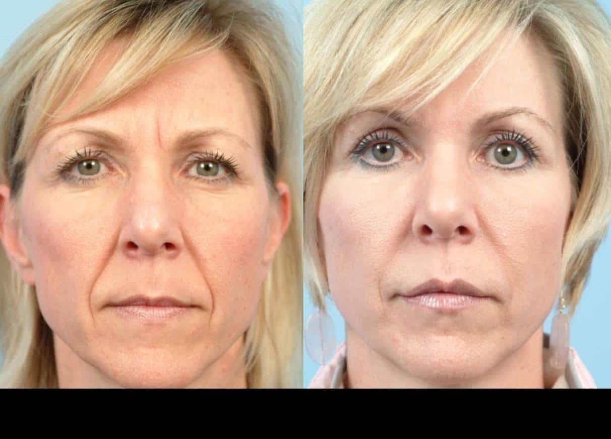 Dermal Fillers in Toronto Before and After. Image 98