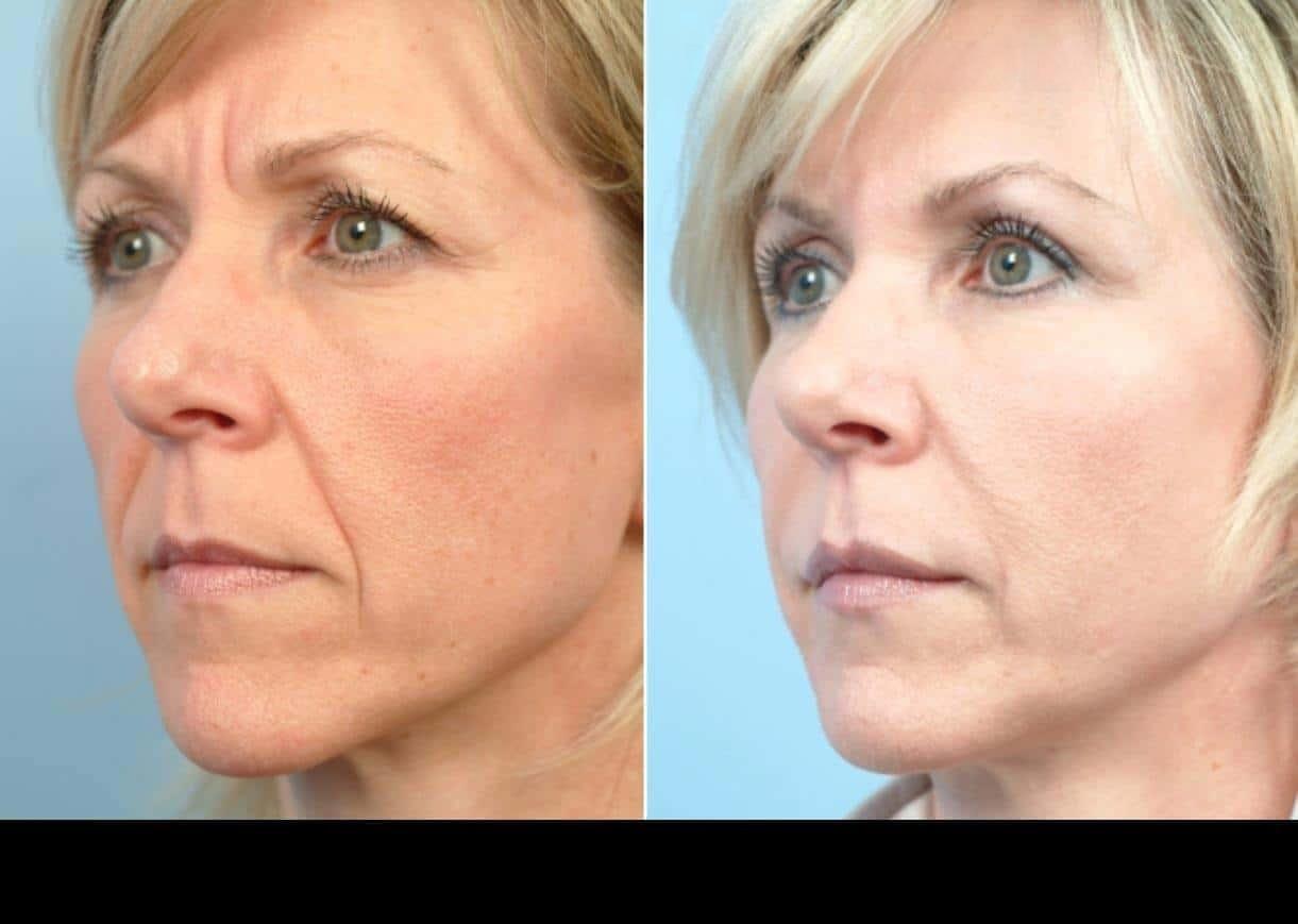 Dermal Fillers in Toronto Before and After. Image 99