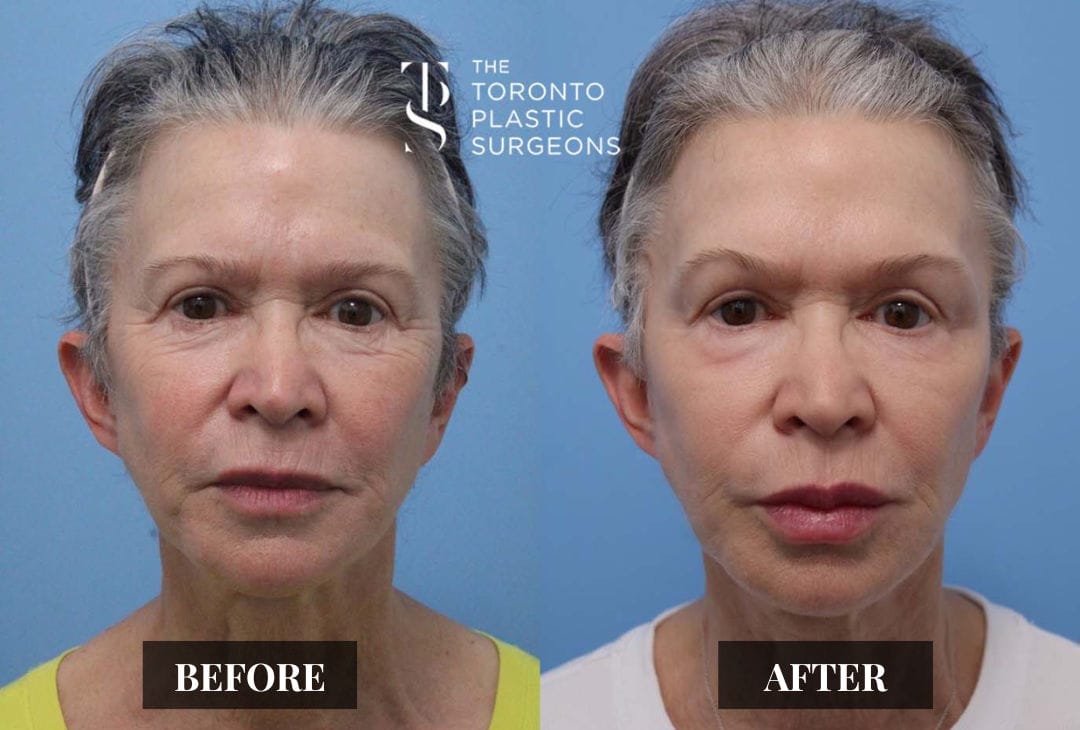 Front-view before and after comparison of a female patient at The Toronto Plastic Surgeons showing smoother skin, reduced facial creases, and improved definition around the cheeks and jawline.