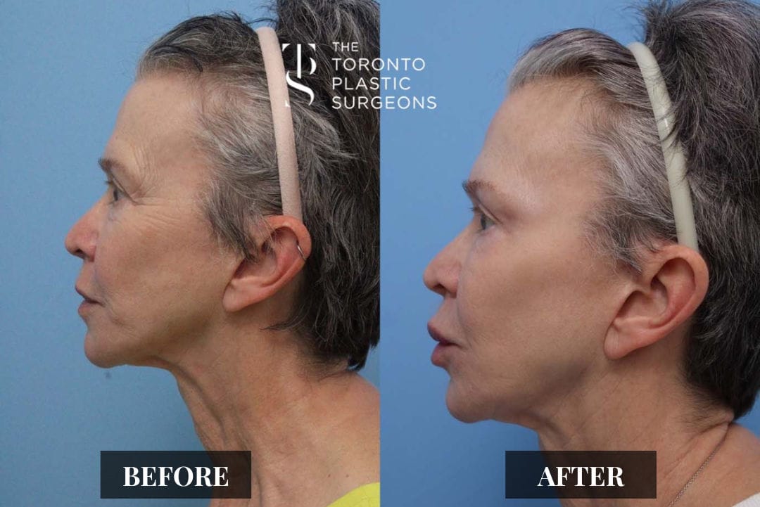Left profile before and after comparison of a female patient at The Toronto Plastic Surgeons showing a tighter jawline, reduced neck sagging, and smoother contour along the lower face.