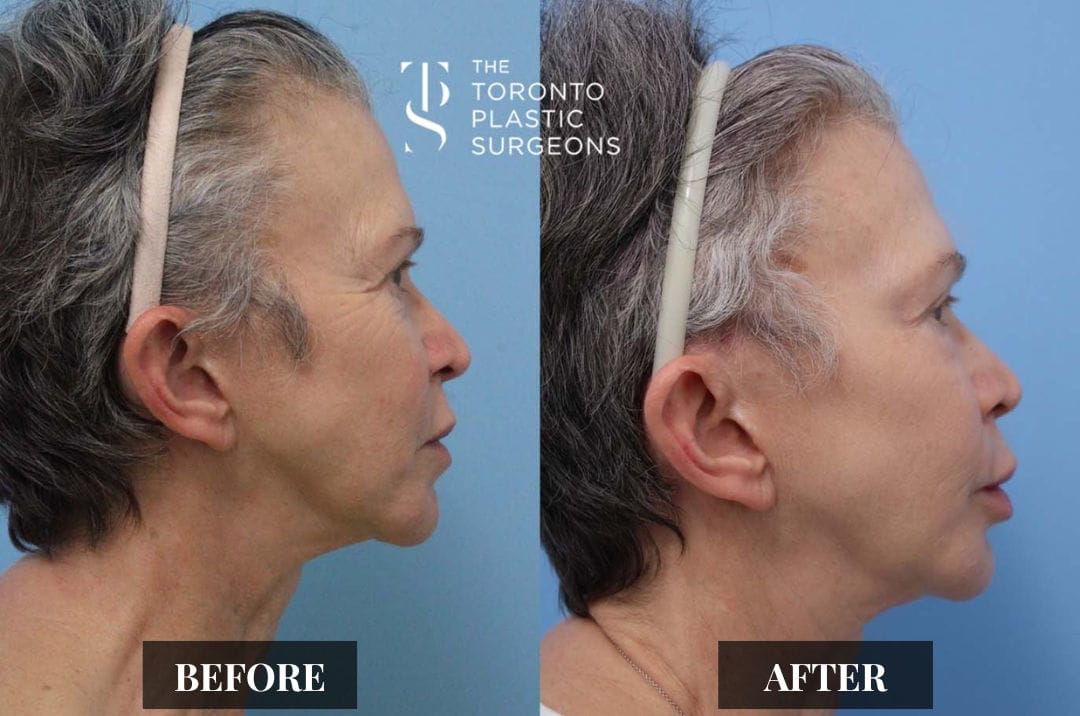 Right profile before and after comparison of a female patient at The Toronto Plastic Surgeons showing improved jaw and neck definition with reduced skin laxity along the lower face.